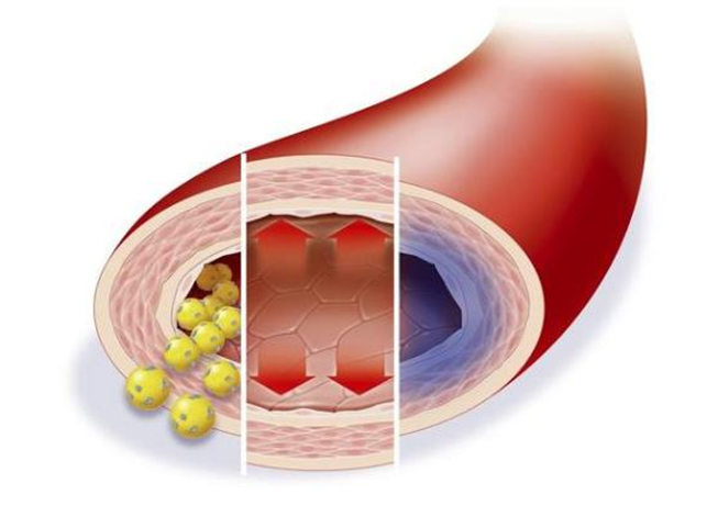 低密度膽固醇超標，多久會影響血管健康？來看看鹽城康復醫(yī)院醫(yī)生怎么說